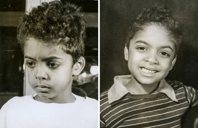 21 Creepy Before And After Pictures Of People Who Underwent Lobotomies