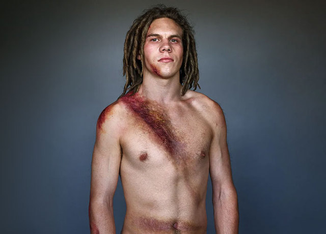 10 Car Crash Survivors Posing For A Shocking Photo Project Aimed To Raise Awareness About Seatbelt Safety