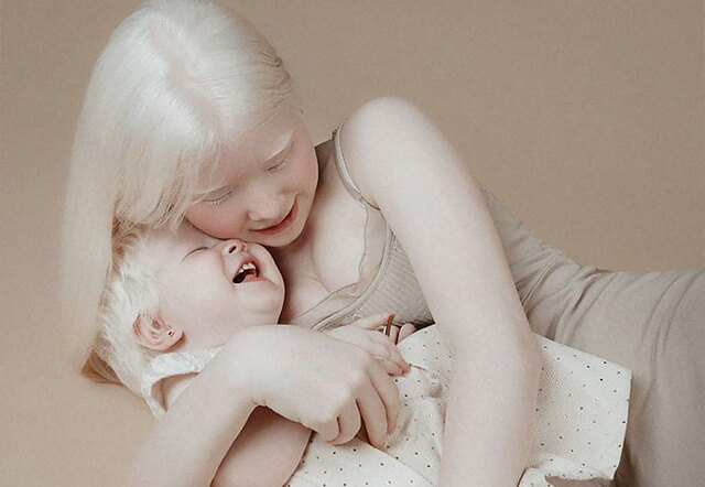 Two Beautiful Albino Sisters Born 12 Years Apart Into The Same Family Are Stunning The Whole World