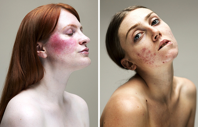 28 Beautiful Photos Of Women With Skin Conditions By Photographer Sophie Harris-Taylor