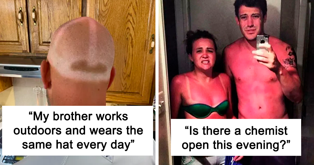 30 Times People Got Sunburns That Are Painful To Even Look At