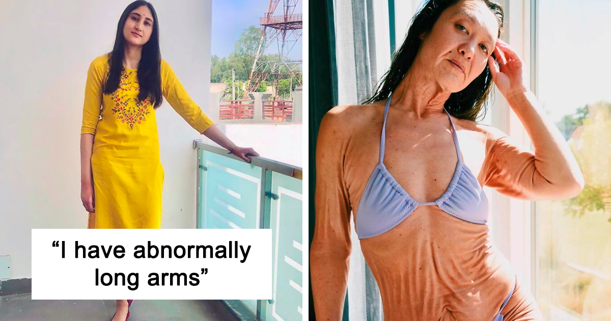 30 Times Unique Genes Made People Stand Out From The Crowd