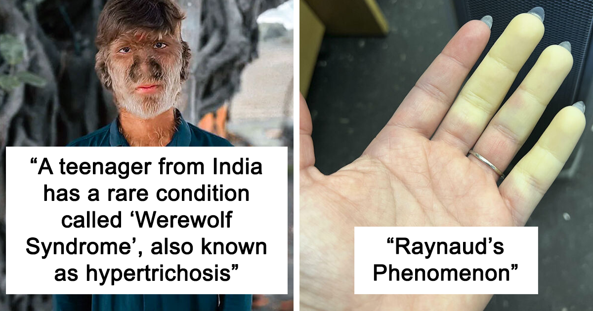 42 People Who Genetically Have Unique Body Characteristics