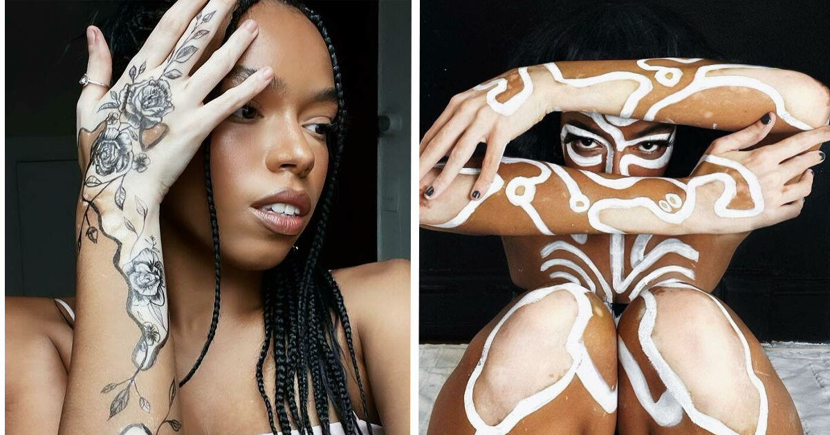 Amara Aleman’s “ArtSpots”: Transforming Vitiligo Into Vibrant Art (20 Pics)