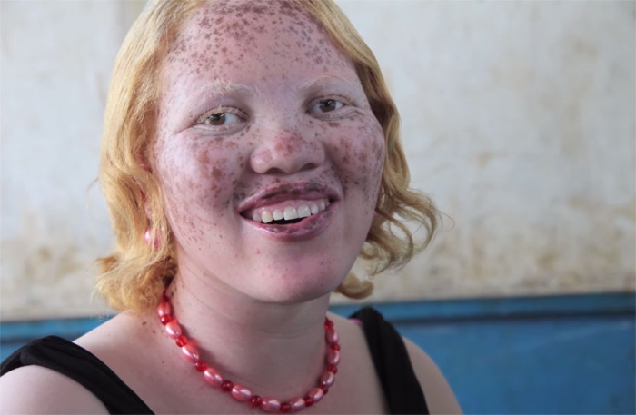 genetic-condition-glamour-shots-on-beauty-positive-exposure-rick-guidotti-20