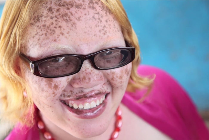 genetic-condition-glamour-shots-on-beauty-positive-exposure-rick-guidotti-14