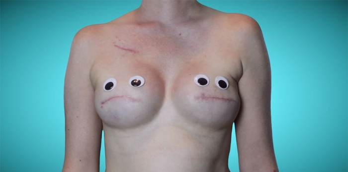 cancer-mastectomy-photo-series-my-breast-choice-aniela-mcguinness-6