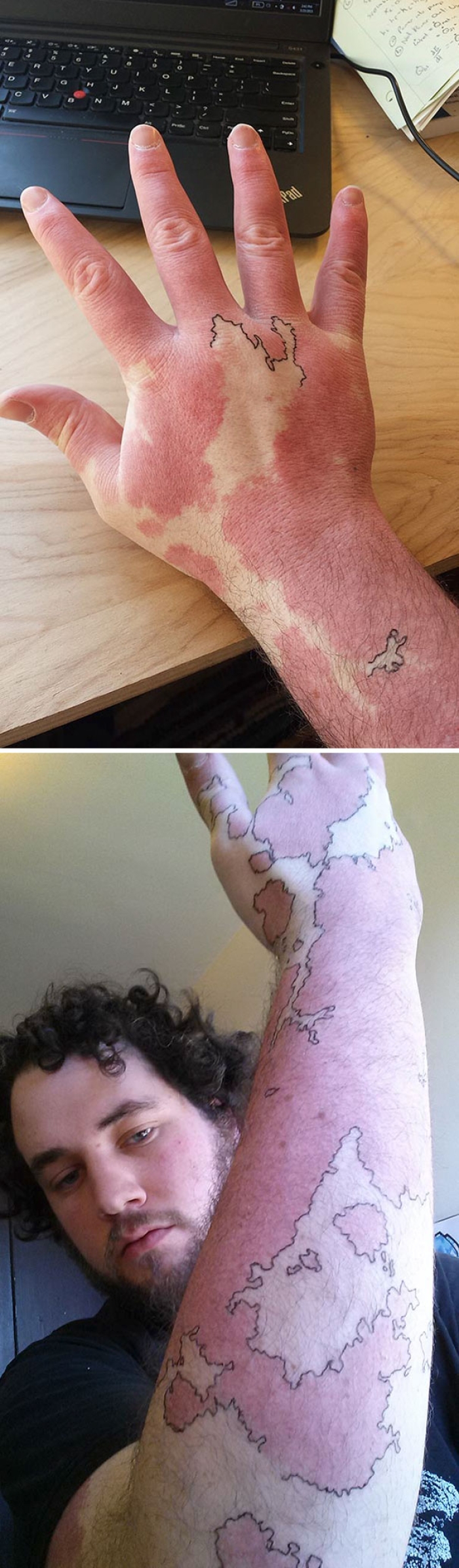 creative-tattoos-birthmark-cover-ups-5
